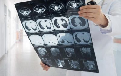 AI and MRI Scans